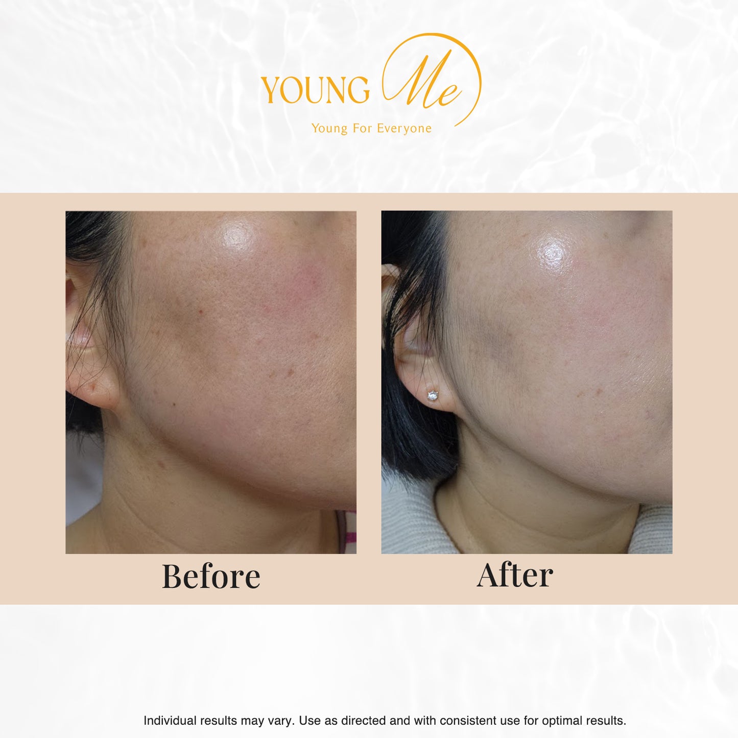 YOUNGME Radiant Glamour UVIR Post Laser Skincare K-Beauty Sheet Mask - Rejuvenating with Premium PDRN, EGF, CICA